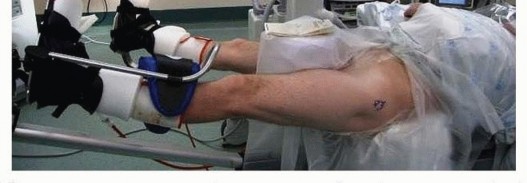 Illustration 15 for Hip Arthroscopy: Your Minimally Invasive Solution for Hip Pain