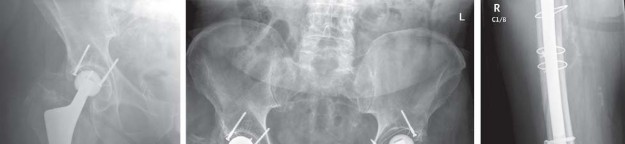 Illustration 22 for Mastering Fractures After Total Hip Arthroplasty