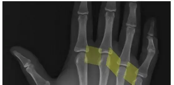 صورة توضيحية لـ كسور عظام اليد (المشط): دليل المريض الشامل للتشخيص والعلاج والتعافي في اليمن والخليج