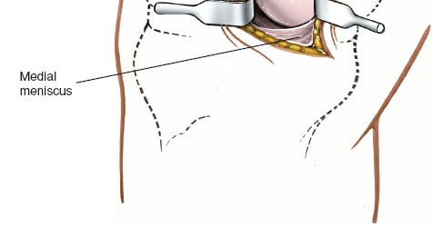 Illustration 55 for Mastering Knee Approaches: Spotlight on Superficial Medial Ligament