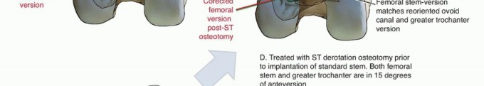 Illustration 8 for Special THA Techniques for Severe Deformities Around the Hip