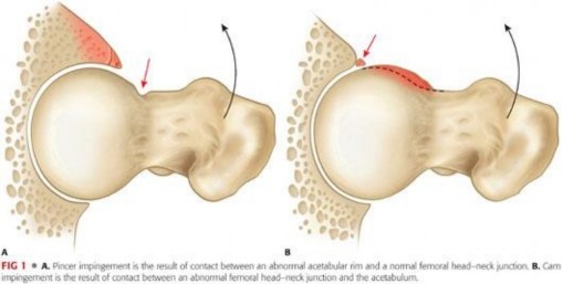 Illustration 18 for Mastering the Scope for Femoroacetabular Impingement