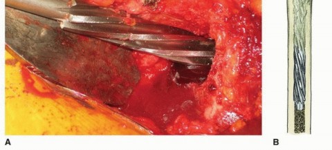 Illustration 15 for Recreate Hip Biomechanics: Modular Stems for Modular Solutions