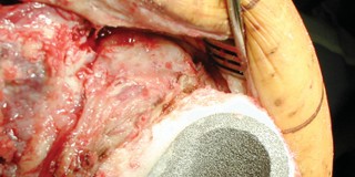 Illustration 16 for Porous Metal Cones: Biologic Fixation for Severe Bone Loss