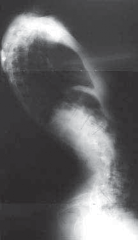 Illustration 28 for Optimizing Instrumentation for Neuromuscular Scoliosis