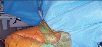 Illustration 15 for PROSTALAC Articulating Spacer: Treat Infected Knees, Regain Mobility