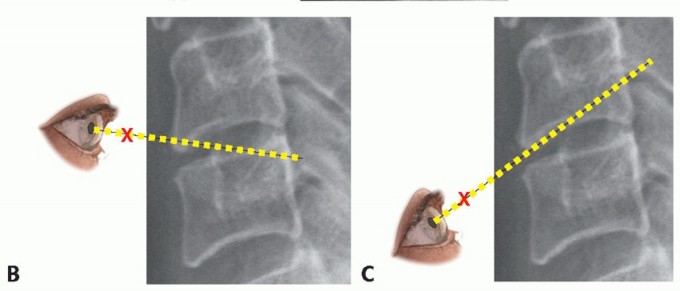 Illustration 9 for How ACDF Clears Your Posterior Disc Space for Lasting Relief