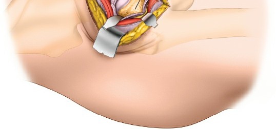 Illustration 94 for Unlocking Every Aspect of the Hip's Surgical Approaches