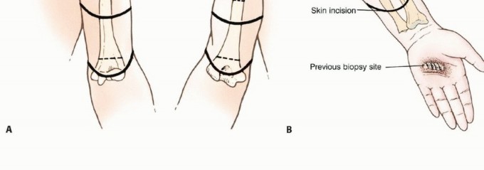 Illustration 2 for Above-Elbow & Below-Elbow Amputations: When & Why They're Needed