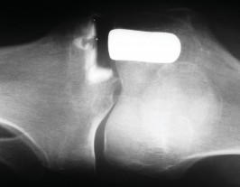 صورة طبية: جراحة استبدال مفصل الركبة الجزئي (UKA): تجنب الأخطاء والاستفادة القصوى في صنعاء مع الأستاذ الدكتور محمد هطيف