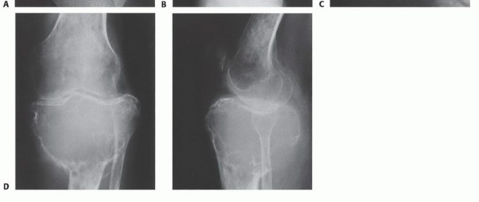 Illustration 17 for Understanding Benign Bone Tumors: Your Complete Preoperative Guide