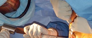 Illustration 23 for Mastering Gap Balancing in Revision TKA: Avoid Common Pitfalls