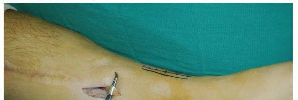 Illustration 40 for Restore Movement: Tendon Transfer for Common Peroneal Nerve Foot Drop