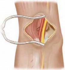 Chapter: Open Reduction for Complex Supracondylar Fractures