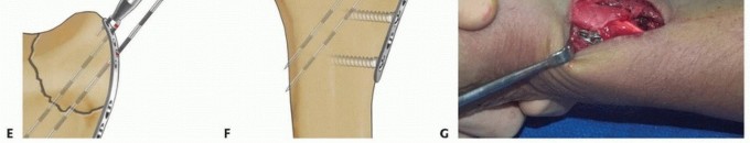 Illustration 34 for Fragment-Specific Fixation: Restore Carpal Facet Horizon