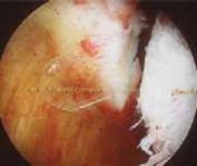 Illustration 2 for Regain Stability: Anterior Shoulder Instability Arthroscopic Fix