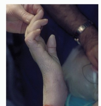 Illustration 8 for Above-Elbow & Below-Elbow Amputations: When & Why They're Needed