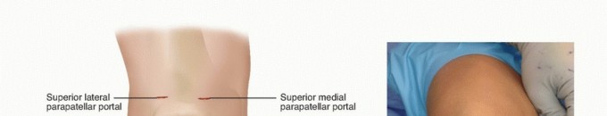 Illustration 11 for Treating Tibial Spine Fractures: Arthroscopy or Open Reduction?