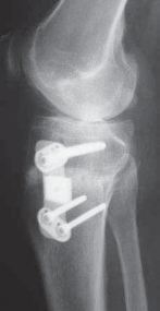 Illustration 44 for Guide Pin Assembly: Key to Flawless Upper Tibial Osteotomy