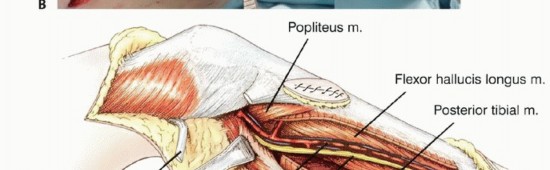 Illustration 21 for Tackling Complex Tumors of the Proximal Tibia: Limb-Sparing Solutions
