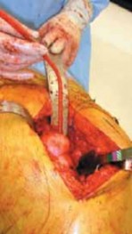 Illustration 30 for Advanced Arthroplasty for Malignant Lesions: Reclaim Your Mobility