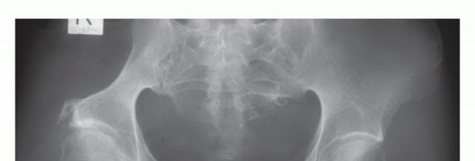 Illustration 29 for Pelvic Metastasis Surgery: A Component of the Utilitarian Approach