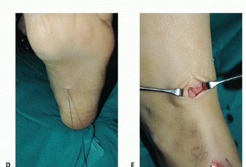 Illustration 53 for Foot Drop Surgery: How a Pin or Drill Elevates Tendon Transfer