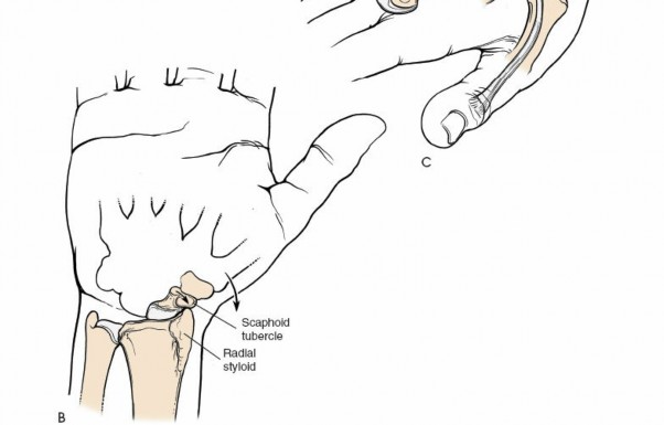 Illustration 49 for Essential Surgical Approaches: Uncover Every Aspect of the Wrist