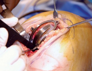 صورة طبية: تقويم مفصل الركبة أحادي الحجرة دليل شامل للمرضى في صنعاء