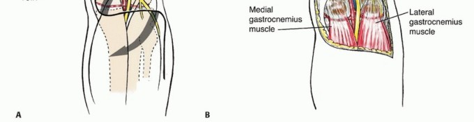 Illustration 10 for Complex Popliteal Resections: Protecting the Greater Saphenous Vein