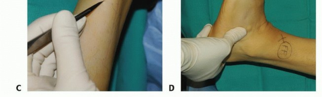Illustration 4 for Foot Drop Surgery: How a Pin or Drill Elevates Tendon Transfer