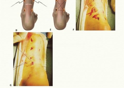 Percutaneous Versus Open Achilles Repair: What's the Difference?