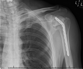 Illustration 60 for Acad Orthop Surg Challenge: Diagnose Shoulder Pain Case 1