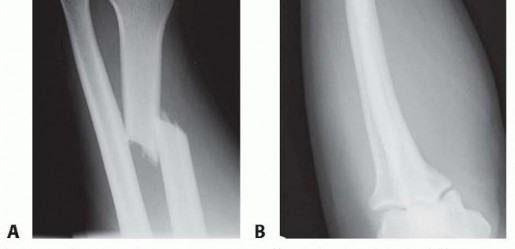 Illustration 2 for Galeazzi DRUJ Stabilization: Unlocking Stability with Smooth Stainless Steel