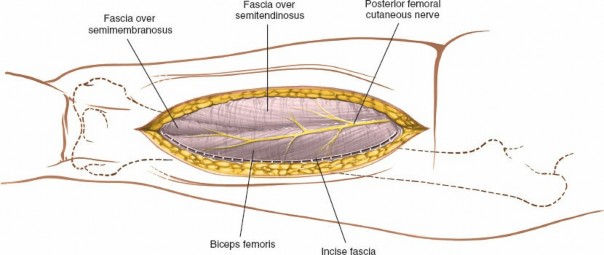 Illustration 39 for Optimal Femoral Approaches: Mastering the Lateral Intermuscular Septum