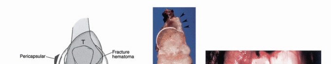 Illustration 10 for Understanding Benign Bone Tumors: Your Complete Preoperative Guide