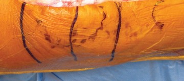 صورة طبية: استبدال مفصل الركبة بالحد الأدنى من التدخل الجراحي: ألم أقل وتعافٍ أسرع مع النهج شبه الرضفي الإنسي