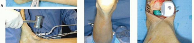 Illustration 16 for HINTEGRA Total Ankle: Unlocking Natural Ankle Movement