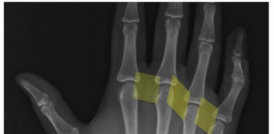Operative Treatment of Metacarpal Fractures