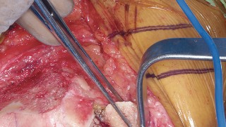 Illustration 51 for Mastering Valgus Total Knee Replacement: Techniques & Pitfalls