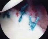 Illustration 33 for Regain Stability: Anterior Shoulder Instability Arthroscopic Fix