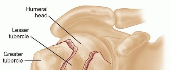 Mastering Percutaneous Pinning for Proximal Humerus Fractures
