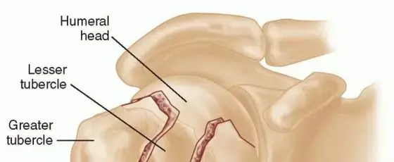 كسور عظم العضد القريب: دليل شامل للعلاج والتعافي مع الأستاذ الدكتور محمد هطيف