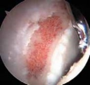 Illustration 18 for Resolving Femoral Head Neck Impingement: Arthroscopic FAI Solutions