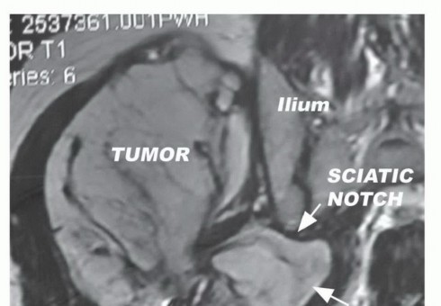 Illustration of preservation of the sciatic - Dr. Mohammed Hutaif