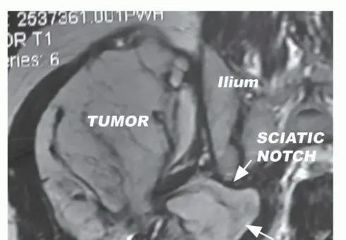 ساركوما الأرداف: الحفاظ على العصب الوركي بدلاً من استئصال نصف الحوض مع الأستاذ الدكتور محمد هطيف