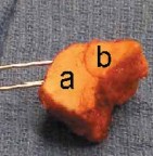 Illustration 43 for Optimizing ORIF for Tibial Plafond Fractures: A Modern Approach