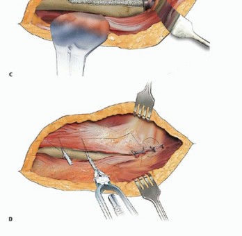 Illustration 8 for Well-Fixed THA Revisions: Precision in the Portion of the Osteotomy