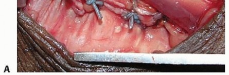 Illustration 16 for Distal Radius Fixation: Precision Through Lister's Tubercle