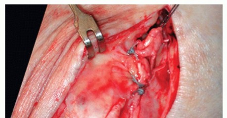 Illustration 36 for Medial Ankle Instability: Find Relief with Reconstruction